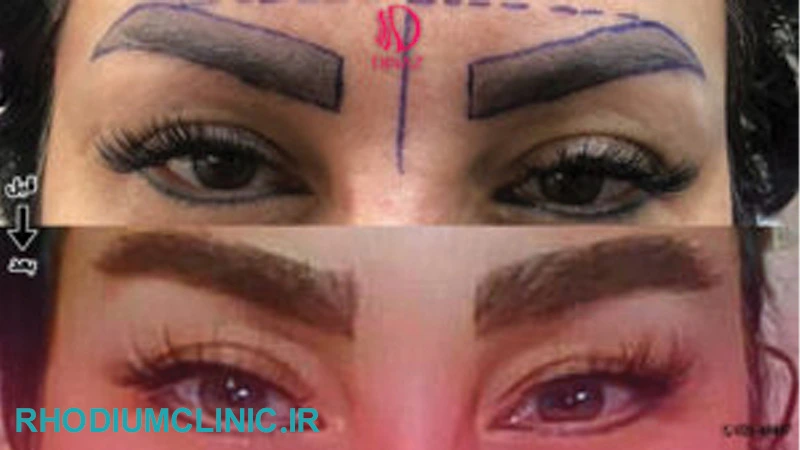 نمونه کار کاشت ابرو کلنییک دیناز