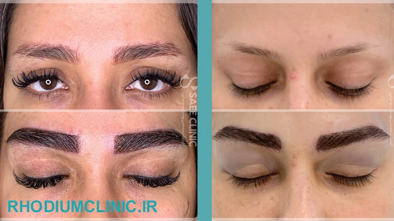 نمونه کاشت ابرو کلینیک ساعی