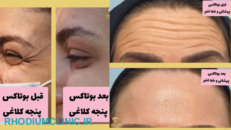 کلینیک آیسان متخصص تزریق بوتاکس گوهردشت