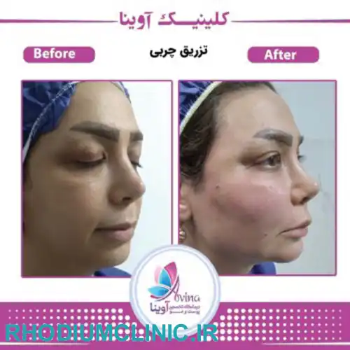 کلینیک تزریق چربی آوینا در کرج