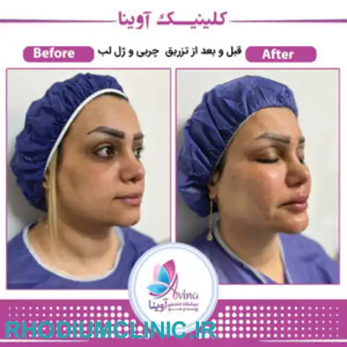کلینیک تزریق چربی آوینا در کرج