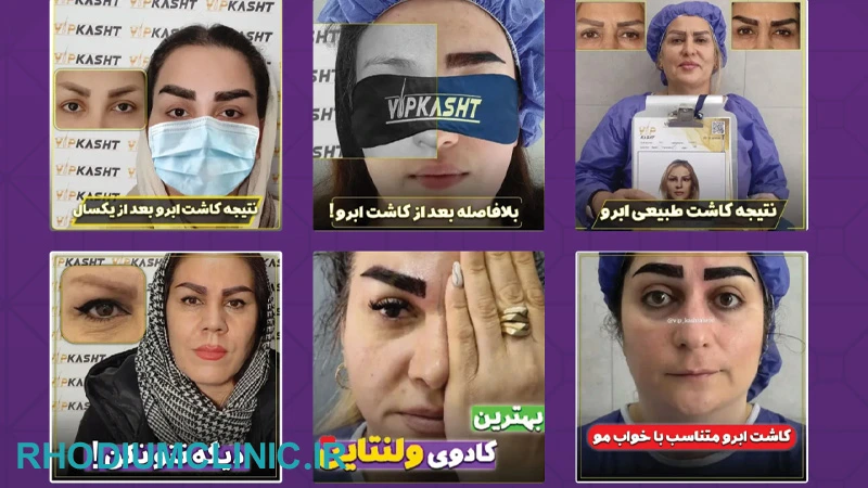 کلینیک کاشت ابرو VIP در تهران
