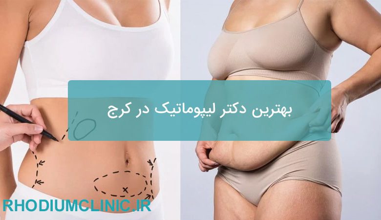 بهترین دکتر لیپوماتیک در کرج