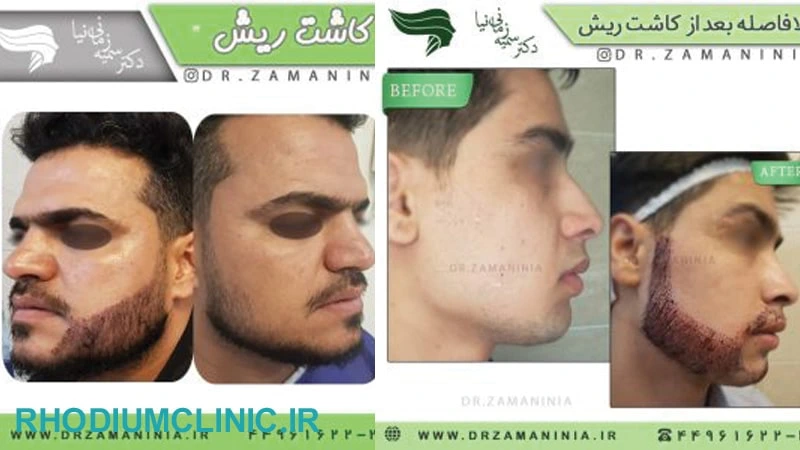 دکتر زمانی نیا، بهترین دکتر کاشت ریش در تهران