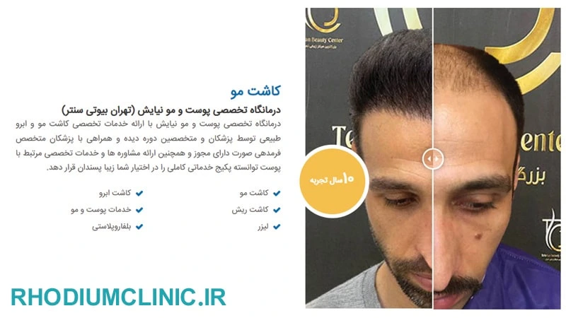 نیایش، یکی از بهترین کلینیک های کاشت ریش در تهران