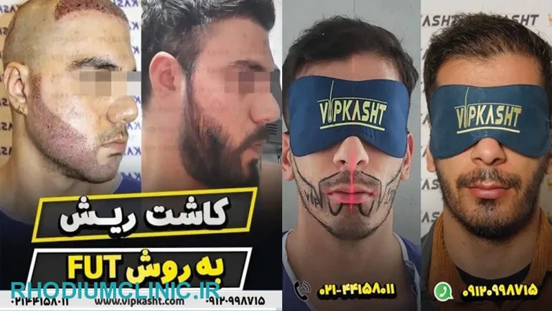 کلینیک VIP برای کاشت ریش و سبیل طبیعی در تهران