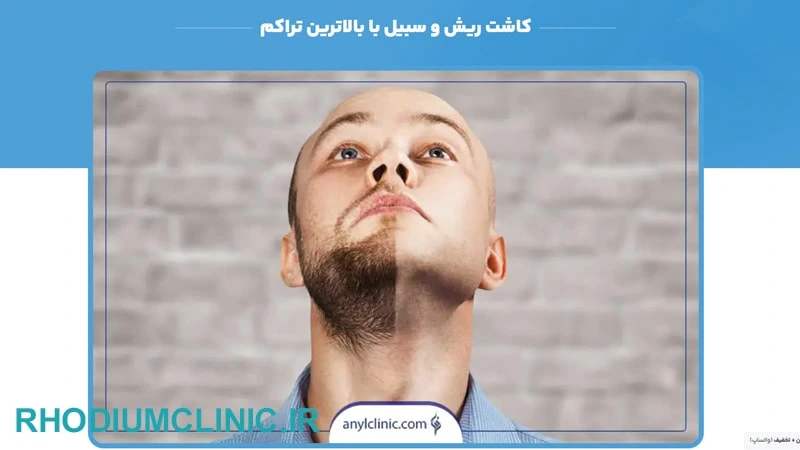 کلینیک آنیل برای کاشت ریش و سبیل طبیعی در تهران