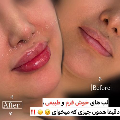 دکتر تزریق فیلر در سعادت آباد