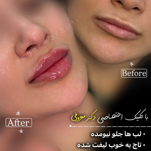 بهترین دکتر تزریق ژل در سعادت آباد