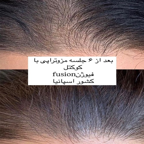 مزوتراپی مو کلینیک زیبایی هروی