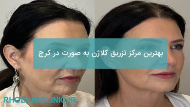 تزریق کلاژن به صورت در کرج