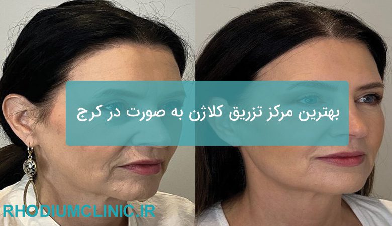 تزریق کلاژن به صورت در کرج