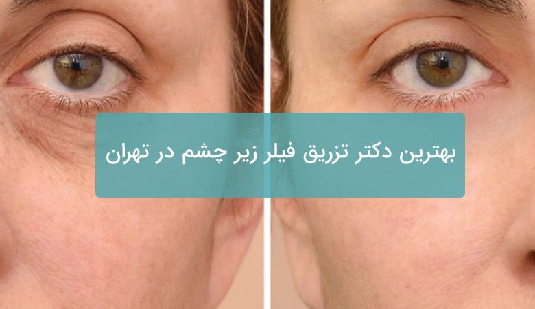 بهترین دکتر تزریق فیلر زیر چشم در تهران