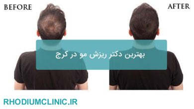 بهترین دکتر ریزش مو در کرج