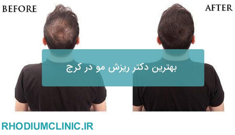 بهترین دکتر ریزش مو در کرج
