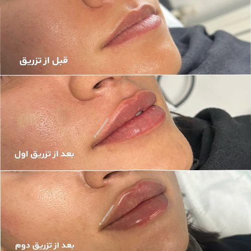 خدمات تزریق فیلر دکتر مهسا سلماسی زاده 