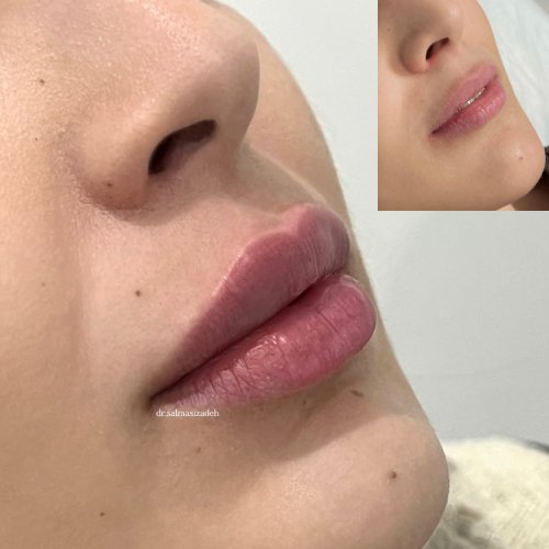 خدمات تزریق فیلر دکتر مهسا سلماسی زاده 