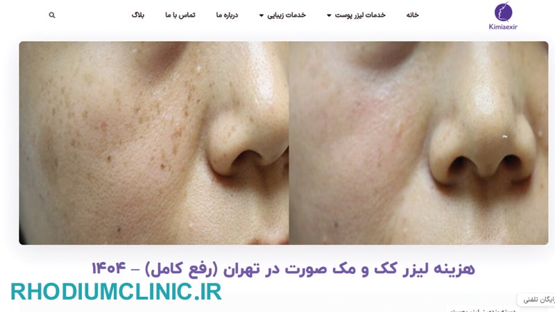 کیمیا اکسیر، مرکز درمان کک و مک در تهران